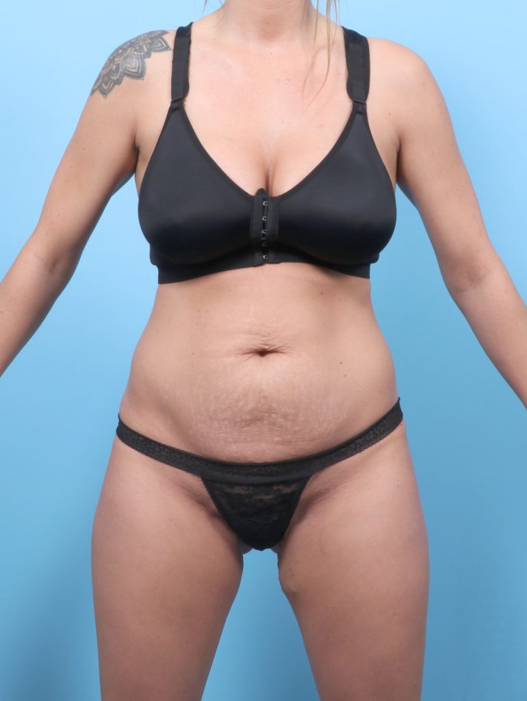 Tummy Tuck - Case 8730 - Before