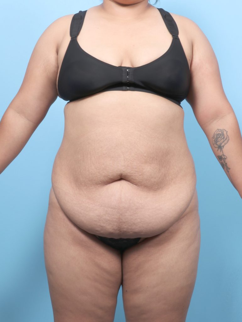 Tummy Tuck - Case 8738 - Before