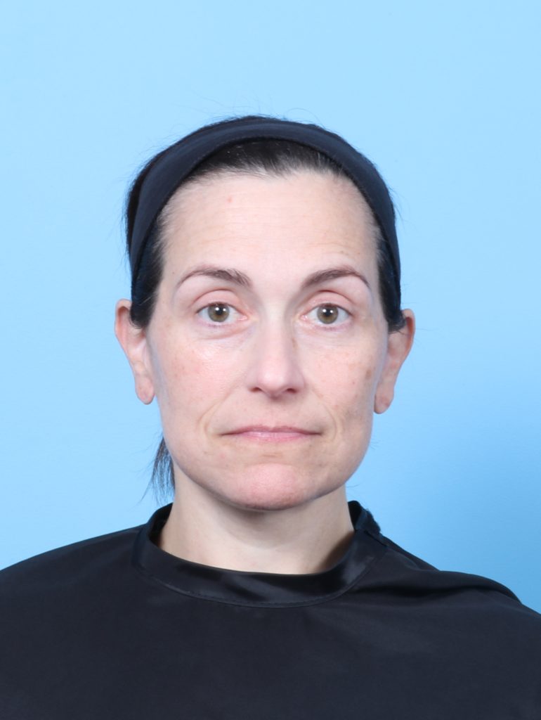 Facelift - Case 8748 - After