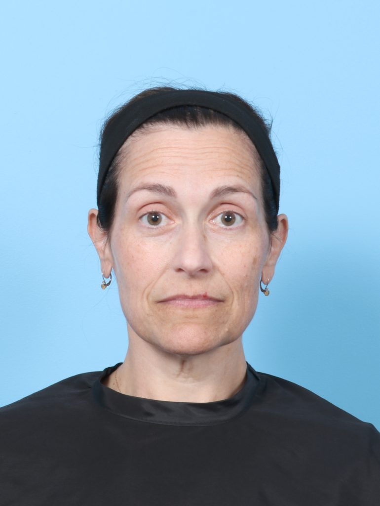 Facelift - Case 8748 - Before