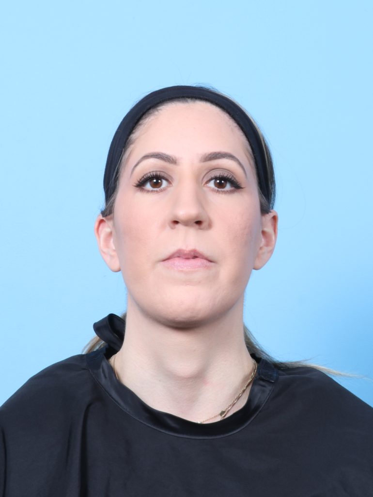 Facelift - Case 8766 - After