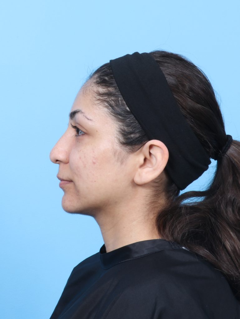Rhinoplasty - Case 8776 - Before