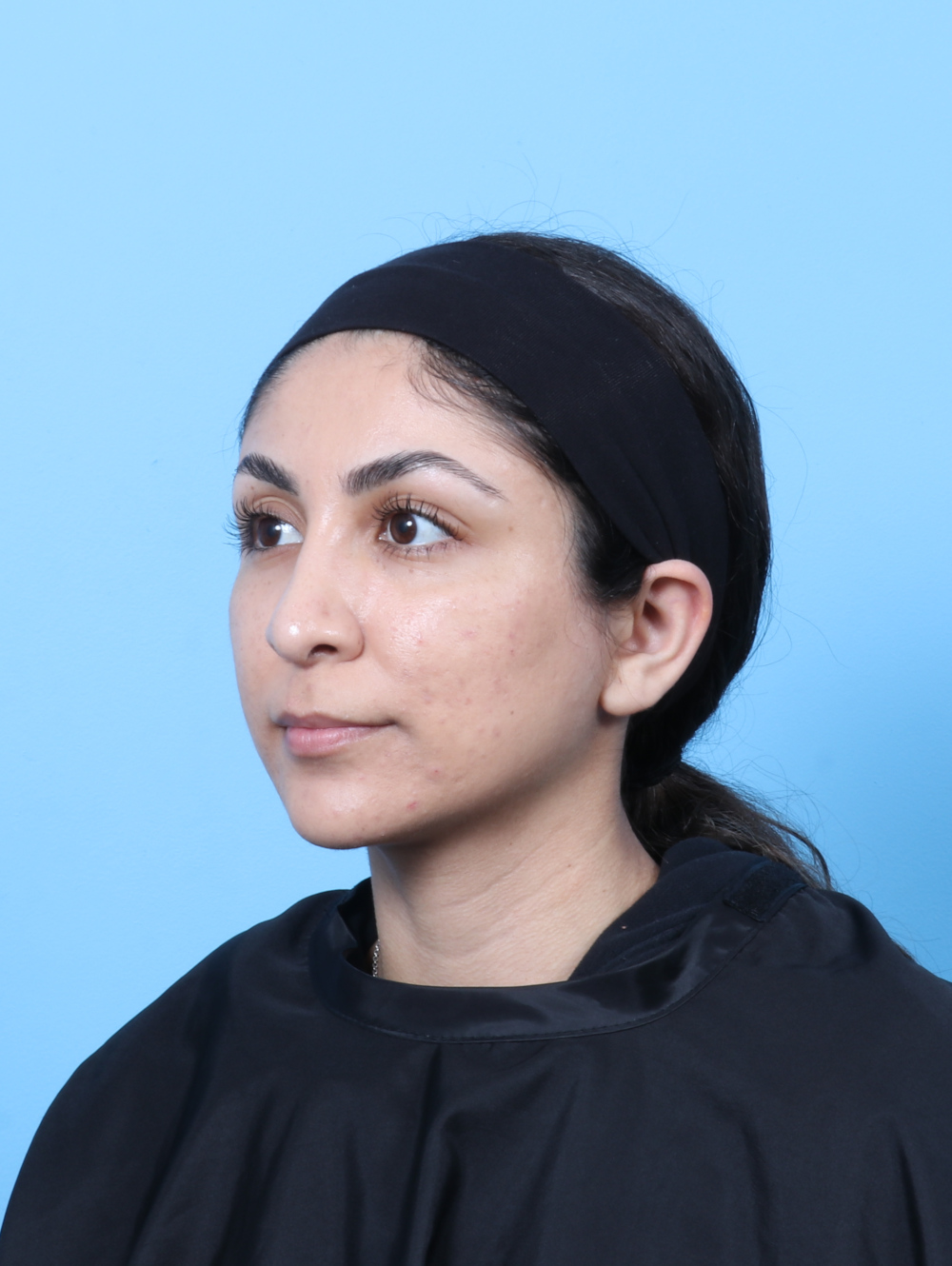 Rhinoplasty Patient Photo - Case 8776 - after view-2