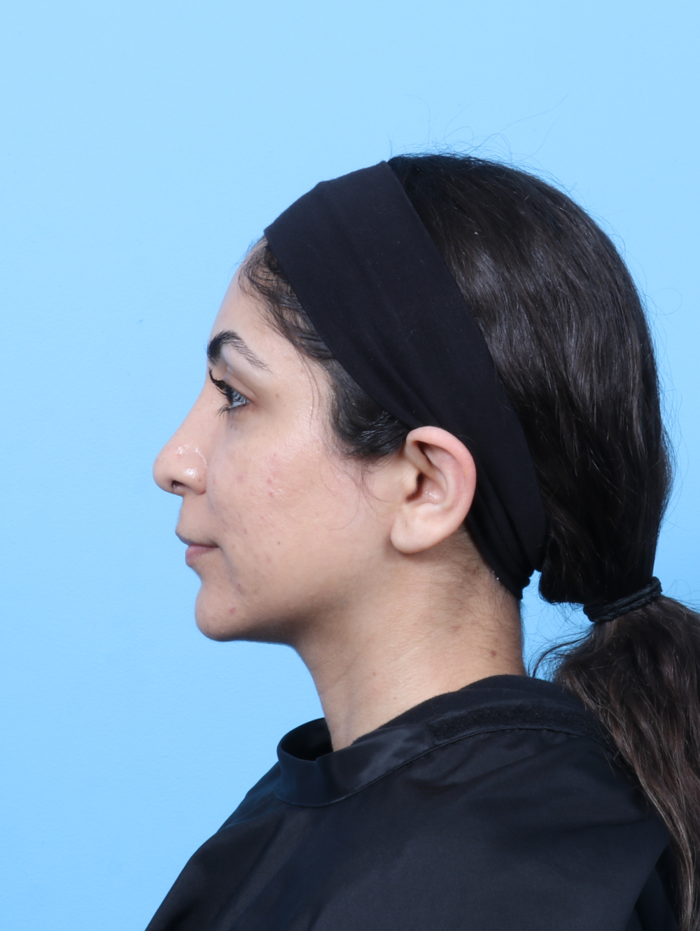 Rhinoplasty Patient Photo - Case 8776 - after view