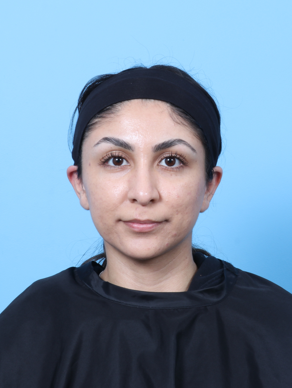 Rhinoplasty Patient Photo - Case 8776 - after view-1