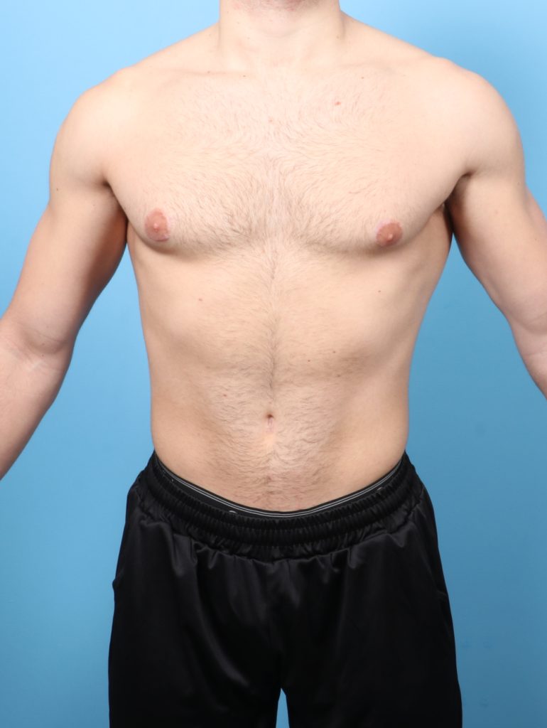 Male Breast Reduction - Case 8800 - After