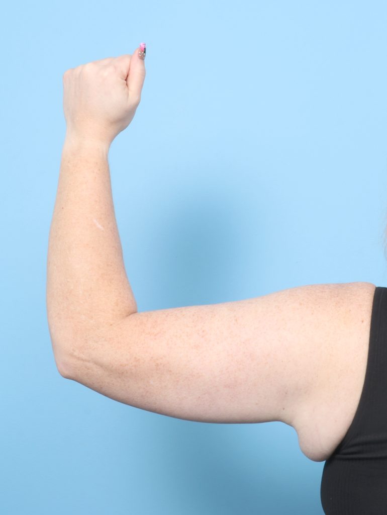 Arm Lift - Case 8808 - After