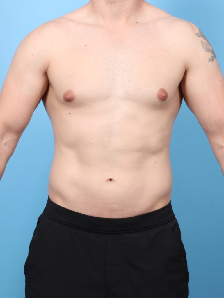 Male Breast Reduction - Case 8822 - Before