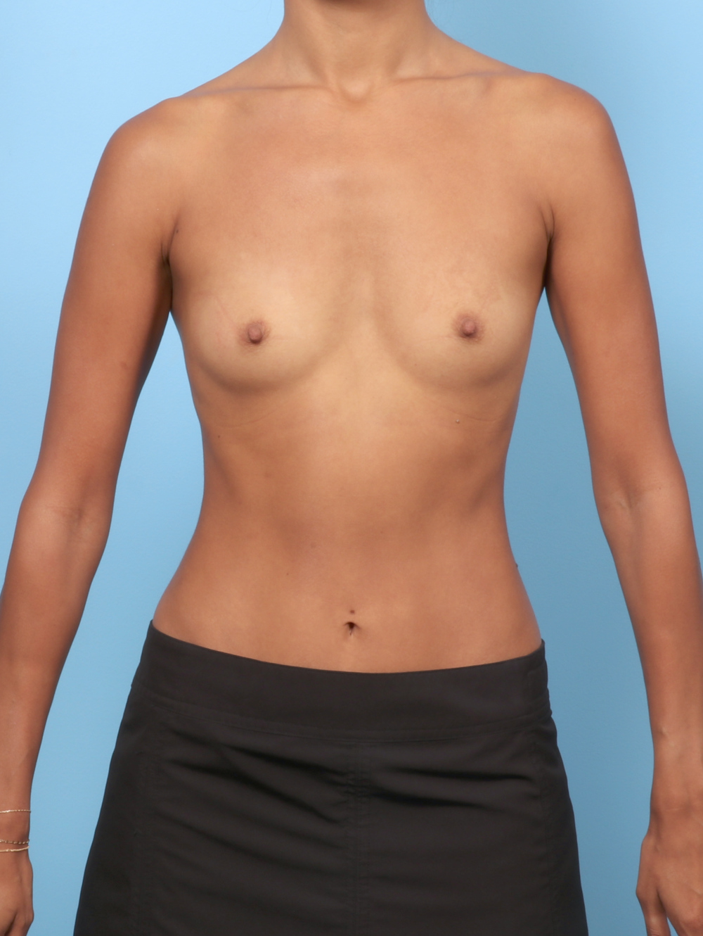 Breast Augmentation Patient Photo - Case 8836 - before view-