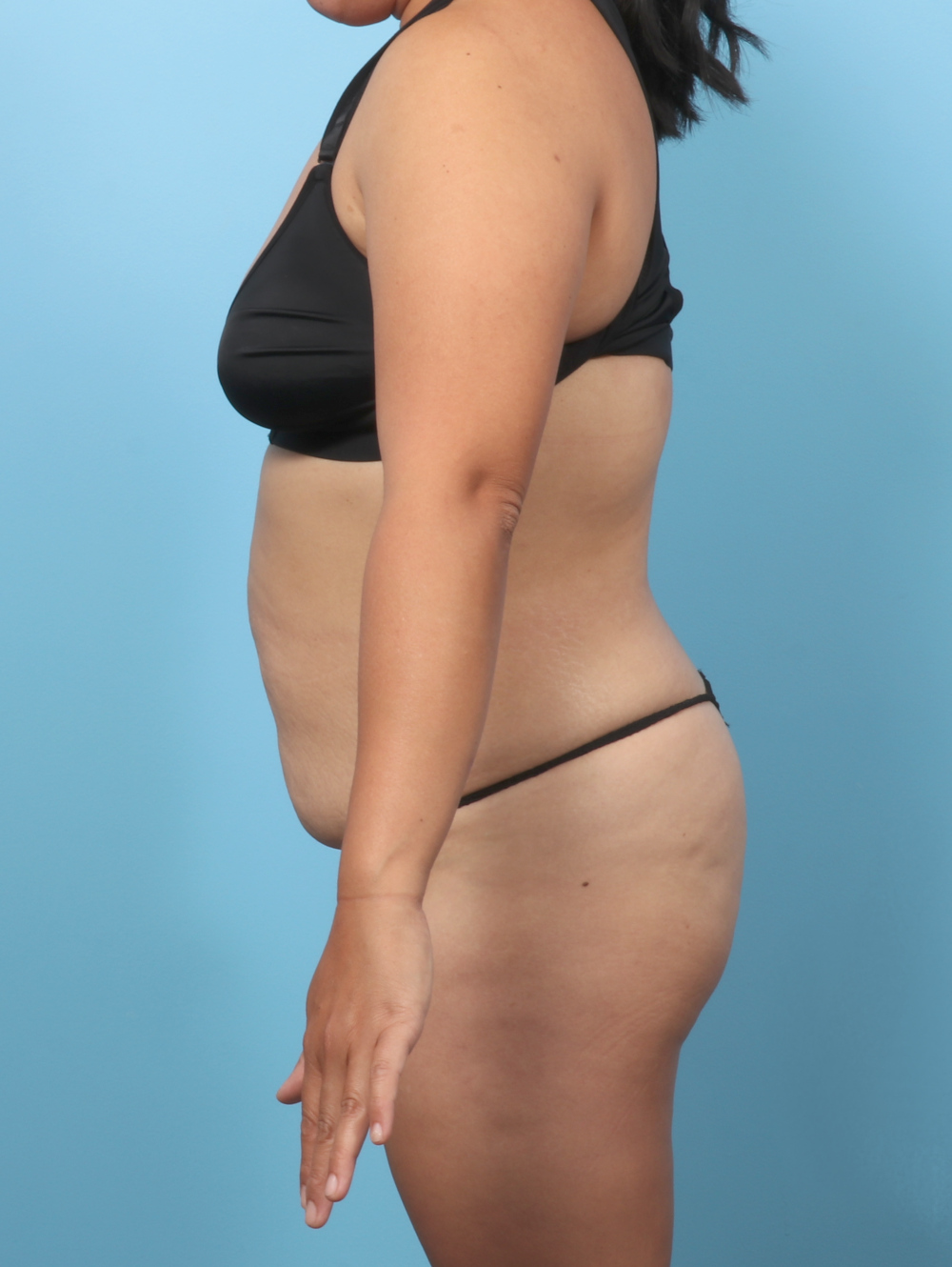 Tummy Tuck Patient Photo - Case 8912 - before view-2