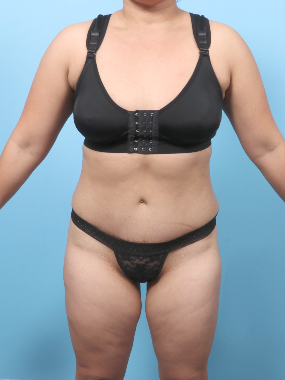 Tummy Tuck Patient Photo - Case 8912 - after view
