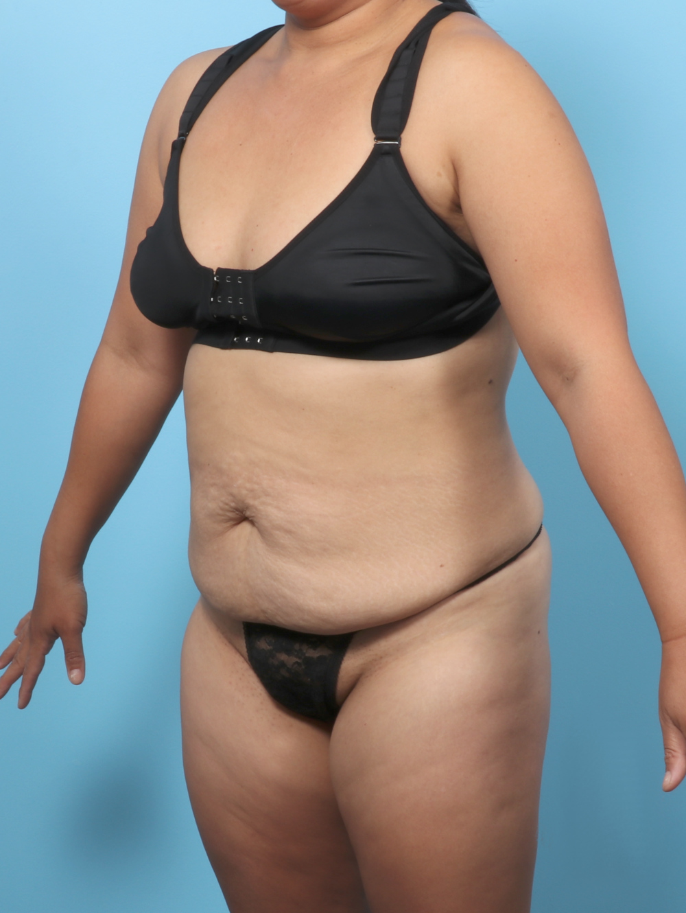 Tummy Tuck Patient Photo - Case 8912 - before view-1