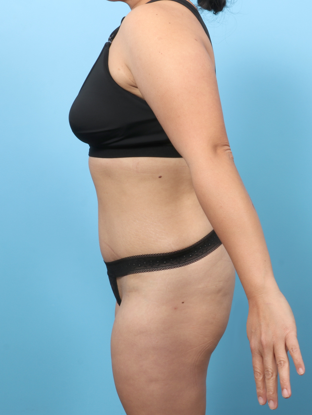 Tummy Tuck Patient Photo - Case 8912 - after view-2