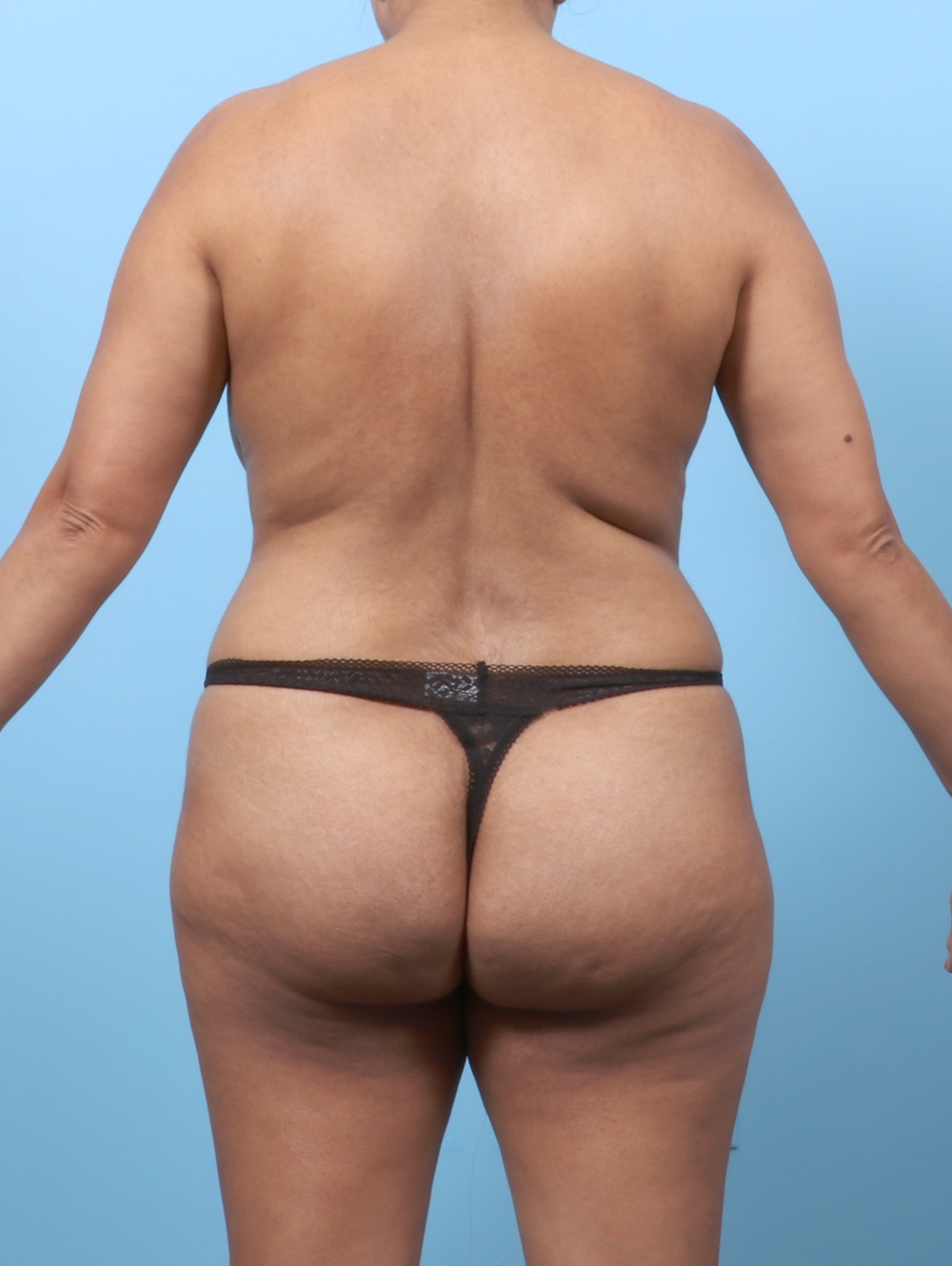 Liposuction Patient Photo - Case 8978 - before view-3
